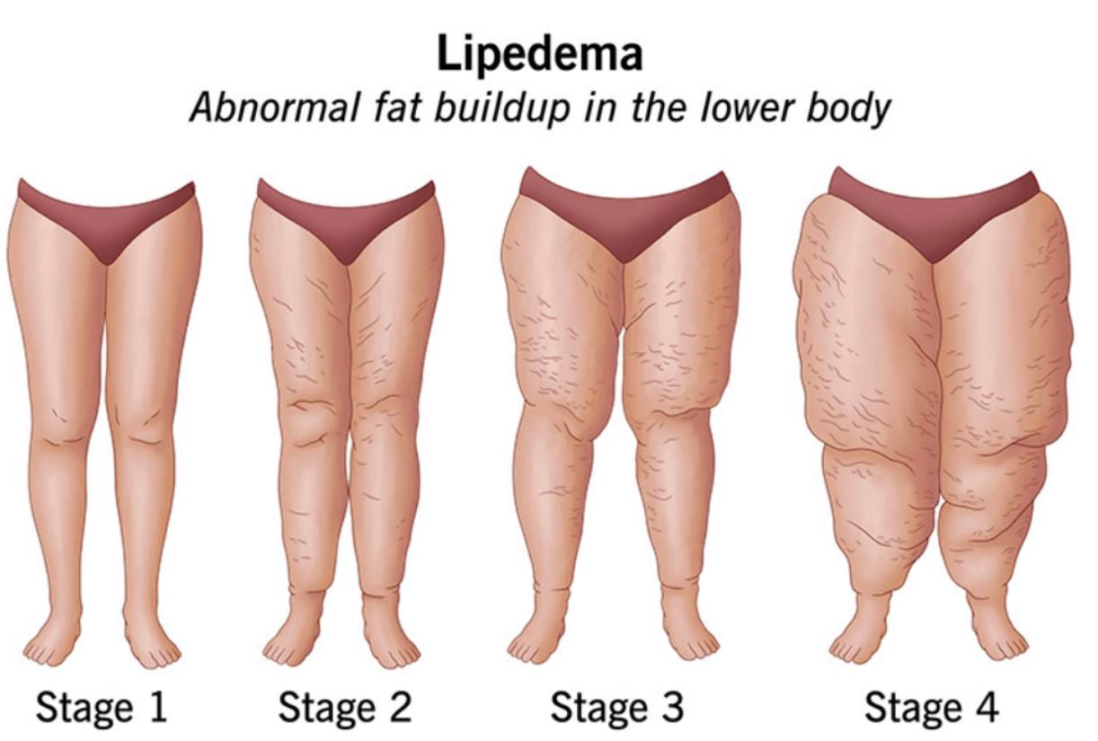 Lipœdème