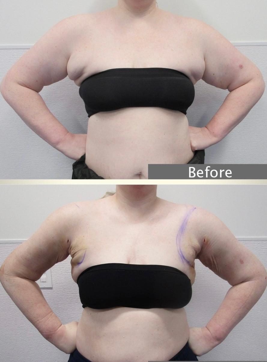 Lipœdème des bras avant et après liposuccion WAL