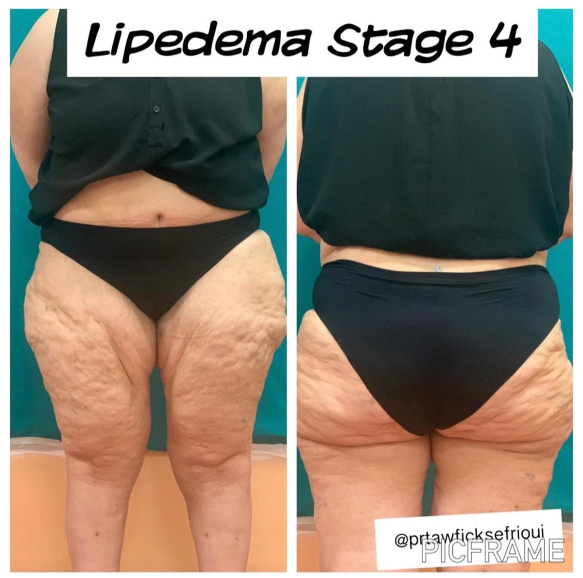 Lipœdème de stade avancé des jambes